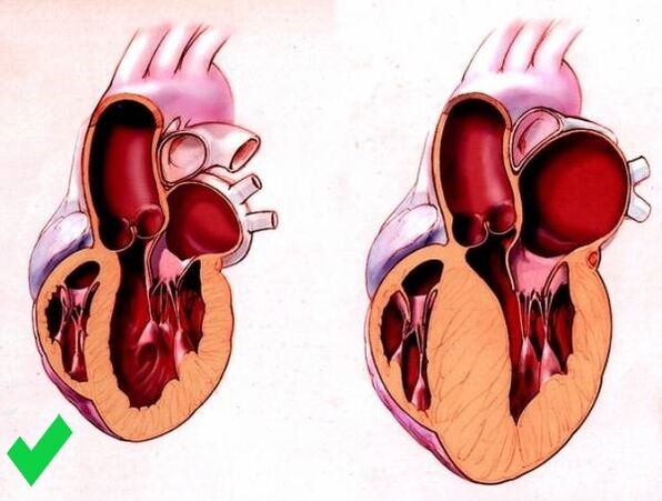 Cardione hoiab ära südame ventrikulaarse hüpertroofia